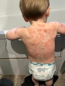 Amélioration de l'eczéma et peau qui sèche 24h après soin énergétique