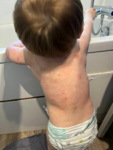 Amélioration de l'eczéma et peau qui sèche 9 jours après soin énergétique