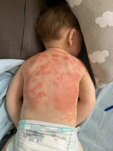 Eczéma inflammatoire sévère sur le dos d'un enfant avant le soin